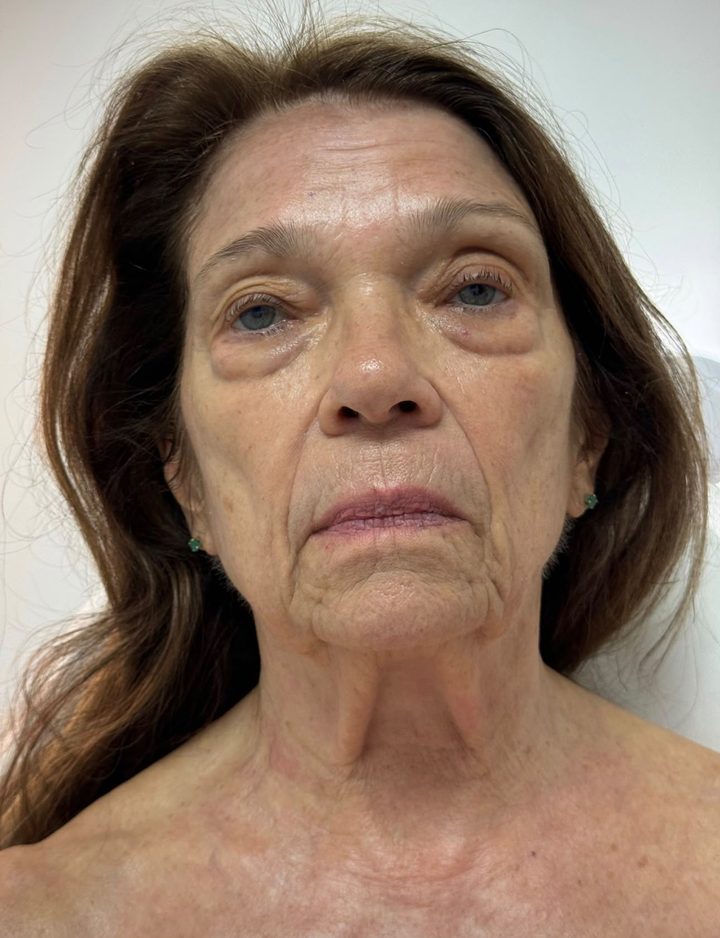 Before LED Face & Neck Lift treatment
