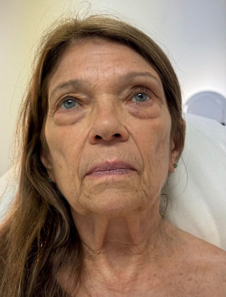 After LED Face & Neck Lift treatment