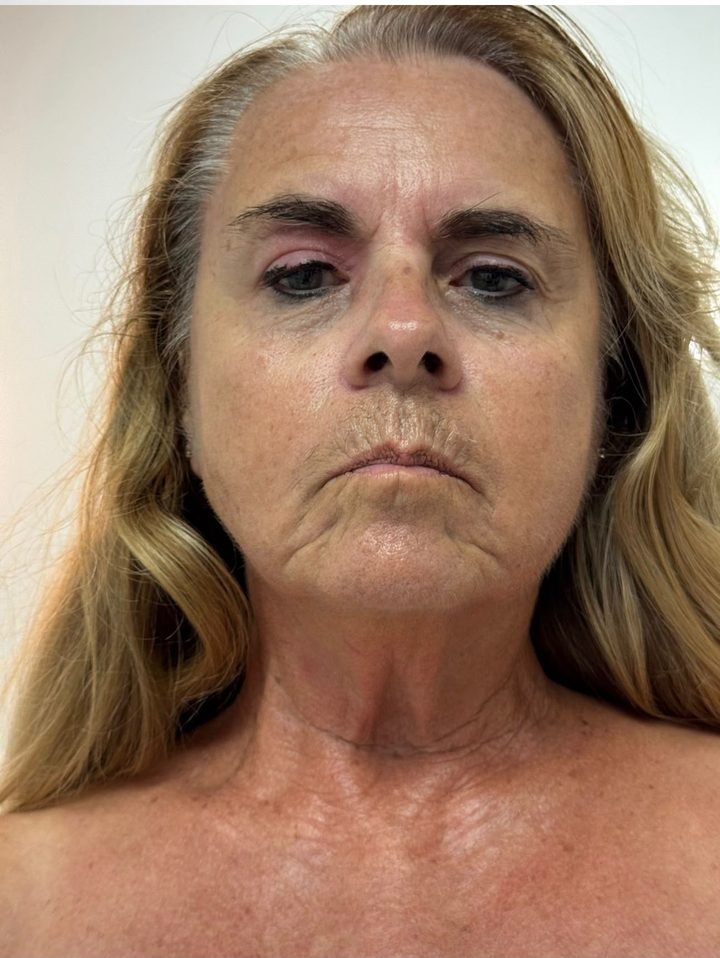 Before LED Face & Neck Lift treatment