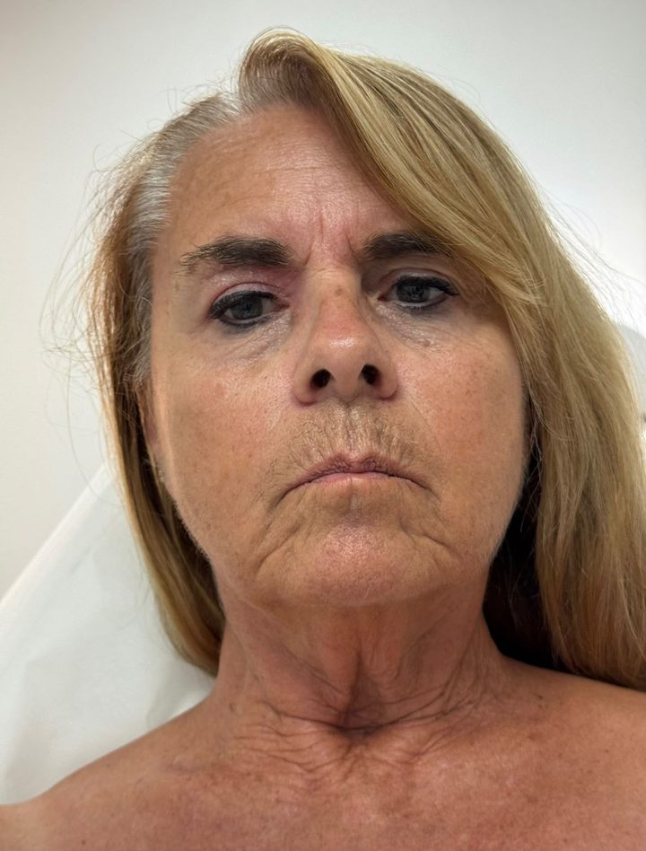 After LED Face & Neck Lift treatment
